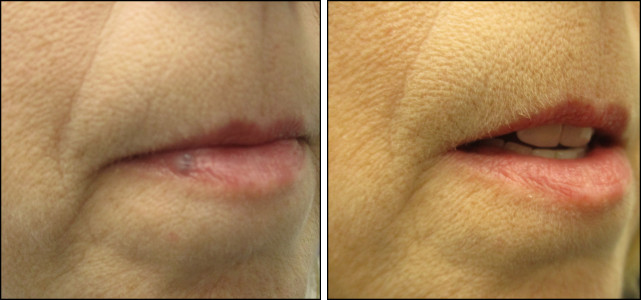 Chicago mole removal shave no scarring